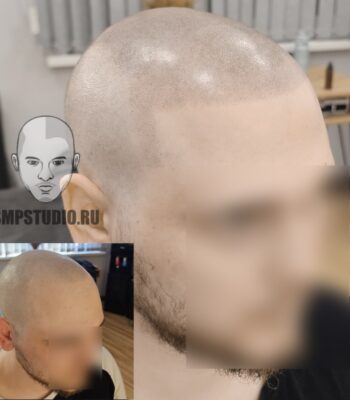 трихопигментация-волос-до-после-scalpmicropigmentation-krasnodar-smpstudio-ru-20