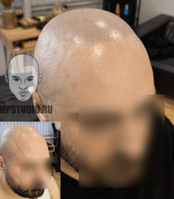 трихопигментация-волос-до-после-scalpmicropigmentation-krasnodar-smpstudio-ru-21