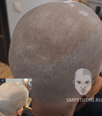 Трихопигментация волос smpstudio.ru Краснодар scalpmicropigmentation