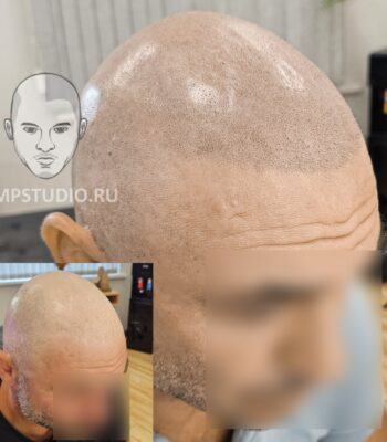 Трихопигментация волос smpstudio.ru Краснодар scalpmicropigmentation после пересадки шрам