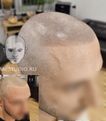 Трихопигментация волос smpstudio.ru Краснодар scalpmicropigmentation