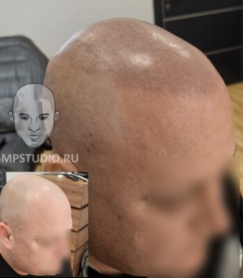 Трихопигментация волос smpstudio.ru Краснодар scalpmicropigmentation