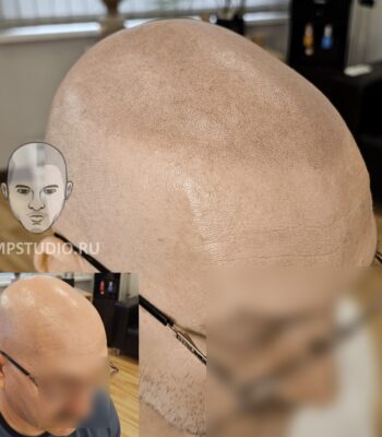 Трихопигментация волос smpstudio.ru Краснодар scalpmicropigmentation