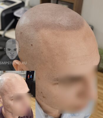 Трихопигментация волос smpstudio.ru Краснодар scalpmicropigmentation Геленджик