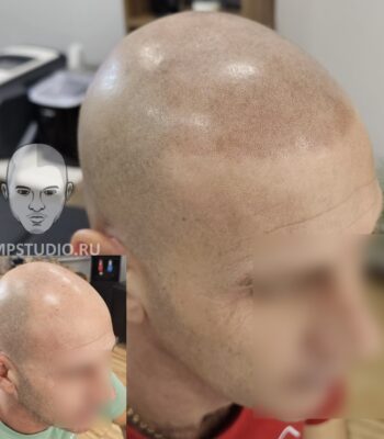 Трихопигментация волос smpstudio.ru Краснодар scalpmicropigmentation