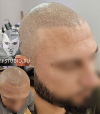 Трихопигментация волос smpstudio.ru Краснодар scalpmicropigmentation после пересадки