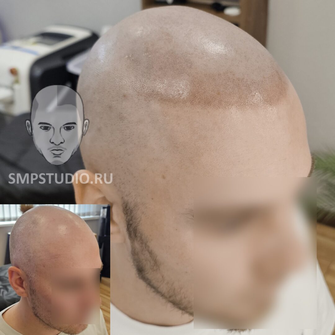 Трихопигментация волос smpstudio.ru Краснодар scalpmicropigmentation
