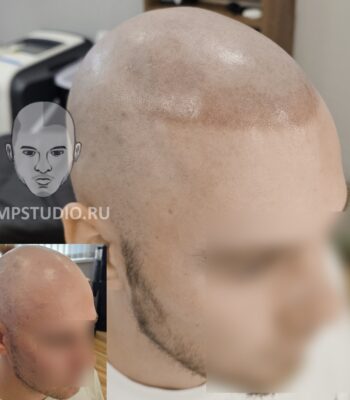 Трихопигментация волос smpstudio.ru Краснодар scalpmicropigmentation