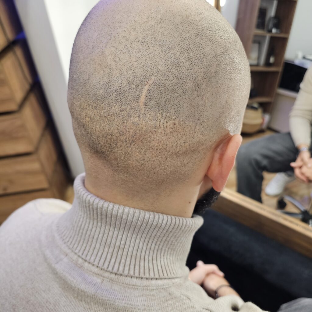 Трихопигментация волос smpstudio.ru Краснодар scalpmicropigmentation