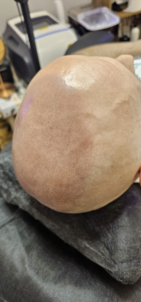 Трихопигментация волос smpstudio.ru Краснодар scalpmicropigmentation