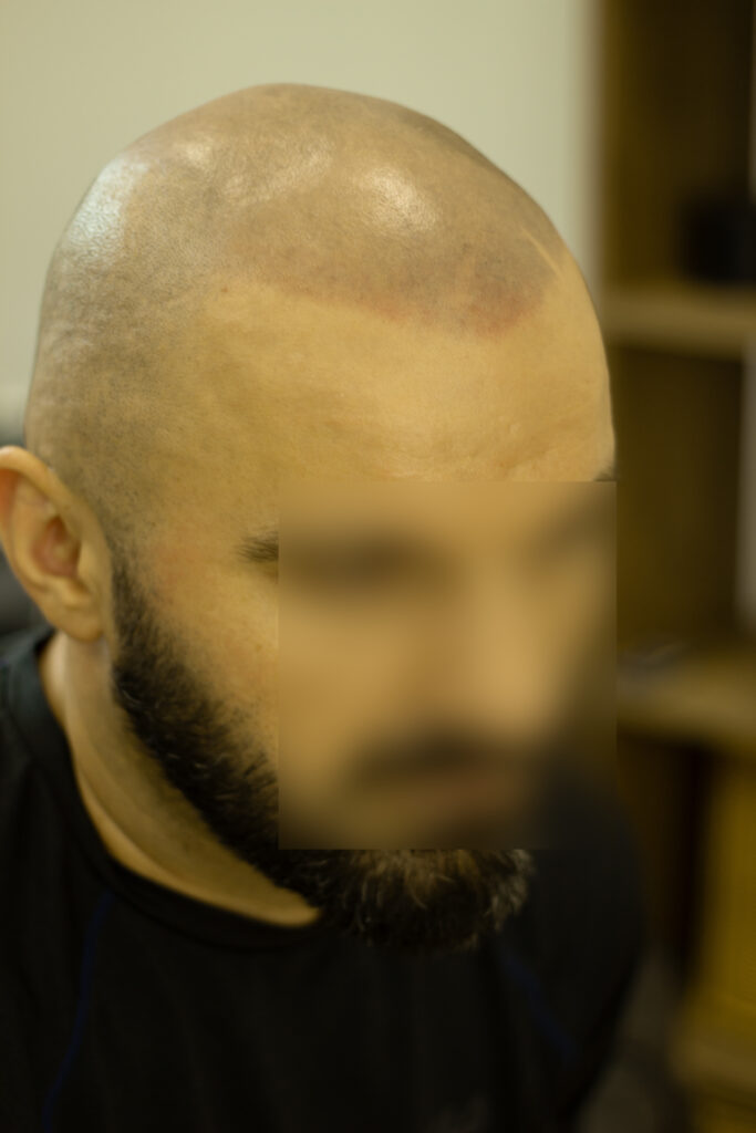 Трихопигментация волос smpstudio.ru Краснодар scalpmicropigmentation