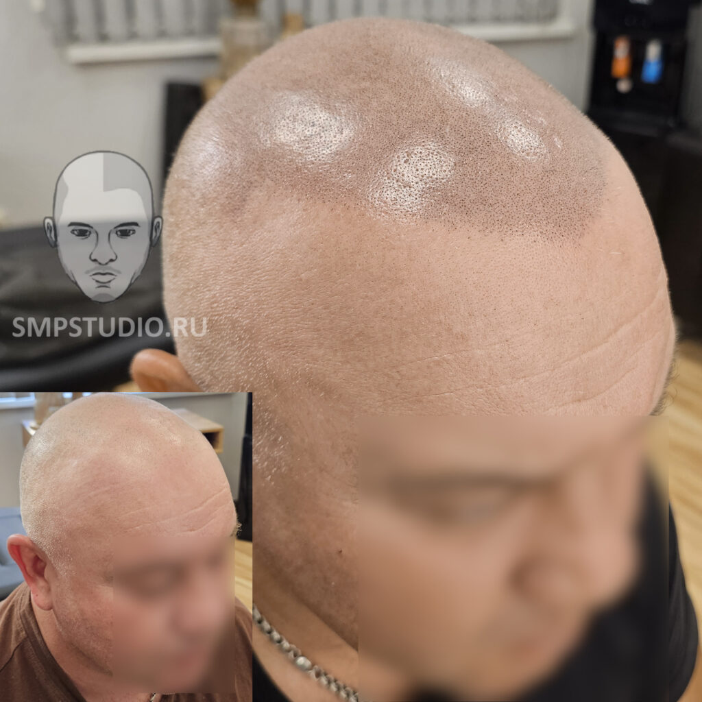 Трихопигментация волос smpstudio.ru Краснодар scalpmicropigmentation