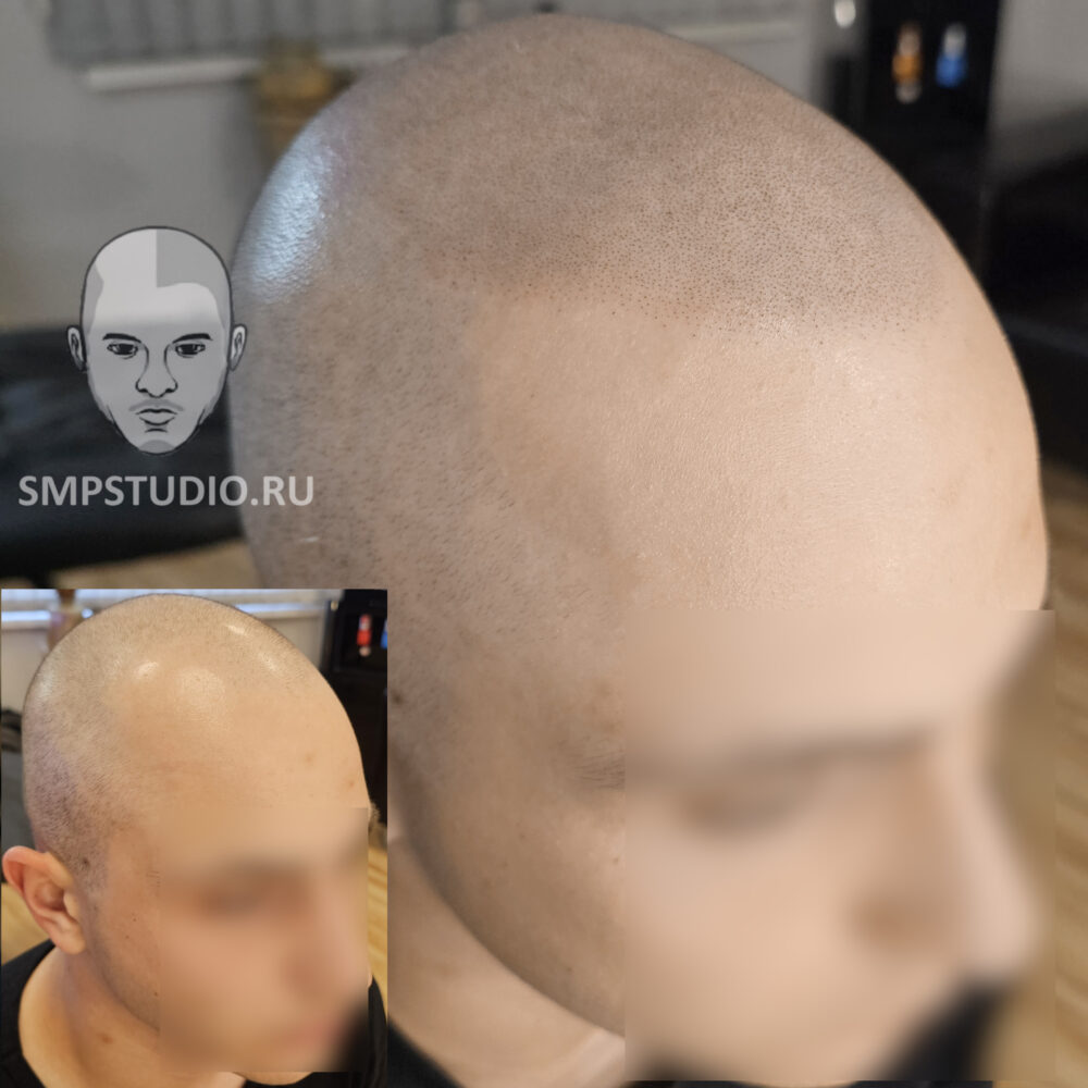 Трихопигментация волос smpstudio.ru Краснодар scalpmicropigmentation