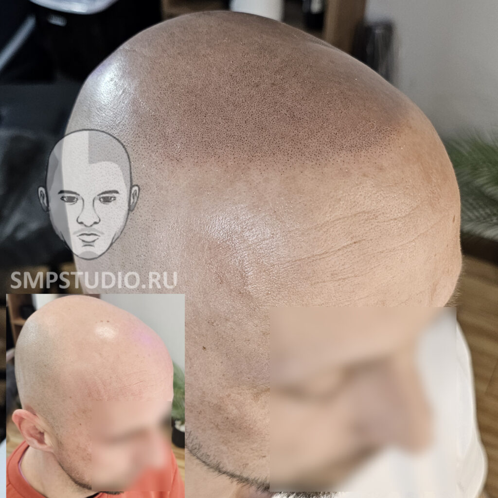 Трихопигментация волос smpstudio.ru Краснодар scalpmicropigmentation