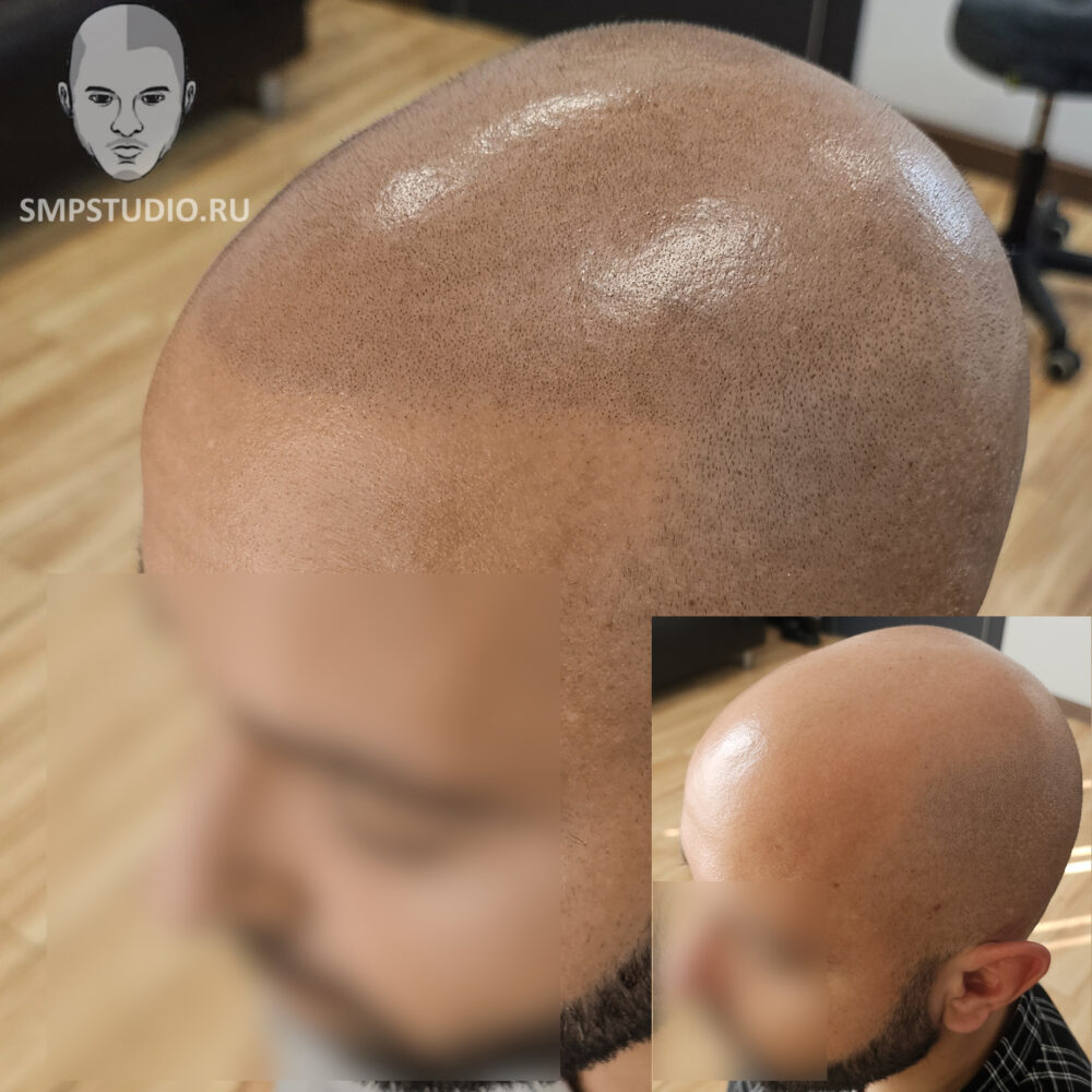Трихопигментация волос smpstudio.ru Краснодар scalpmicropigmentation