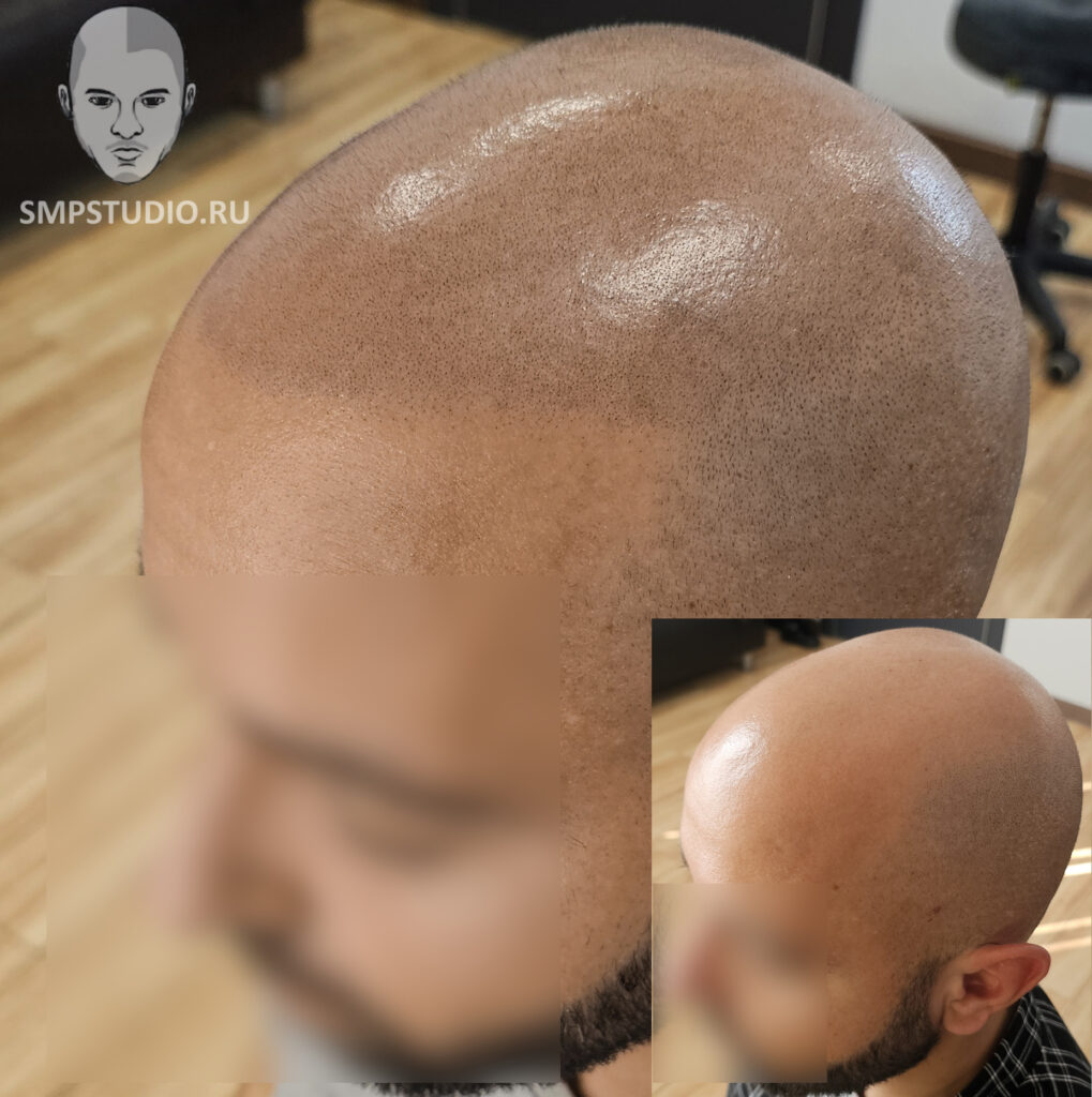 Трихопигментация волос smpstudio.ru Краснодар scalpmicropigmentation