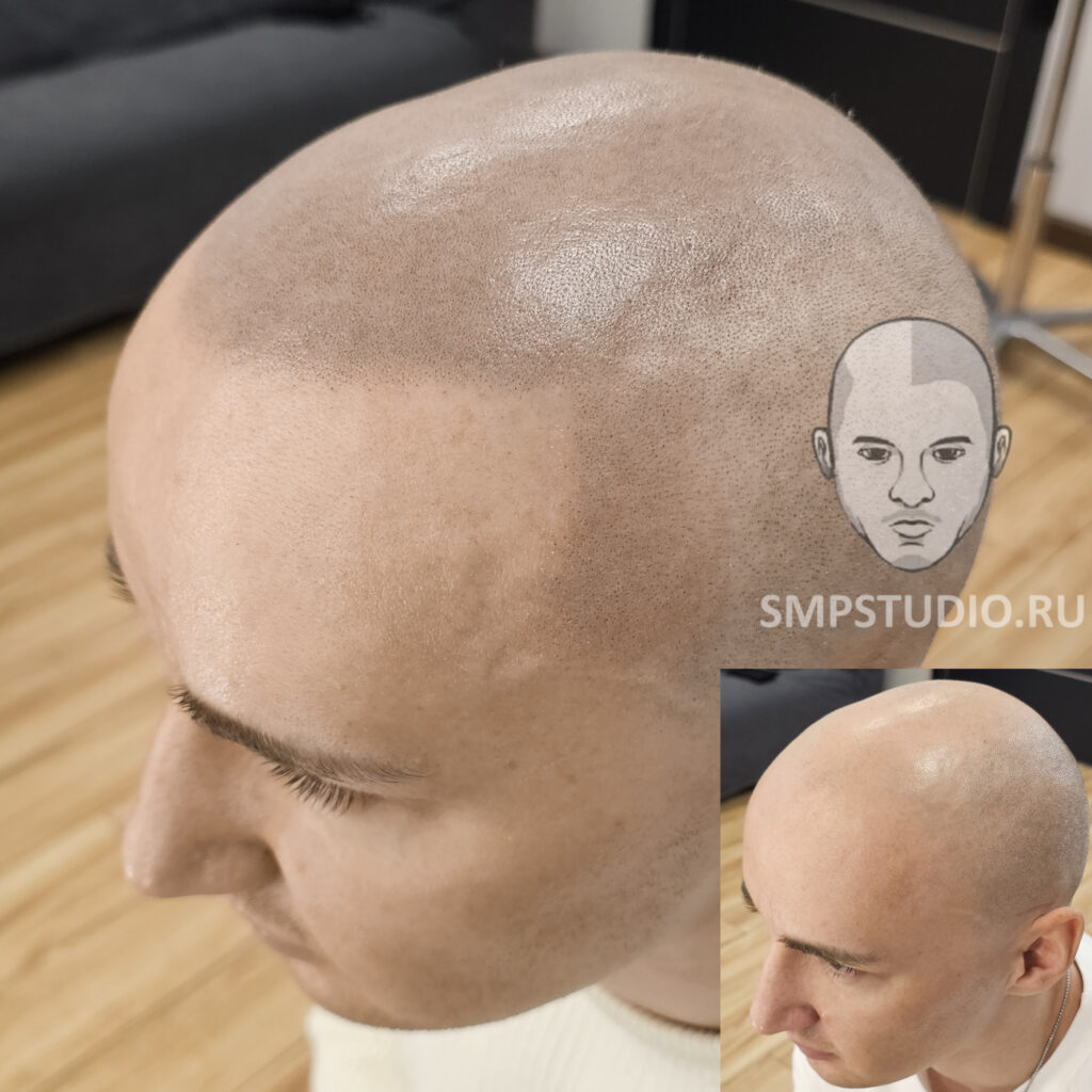 Трихопигментация волос smpstudio.ru Краснодар scalpmicropigmentation