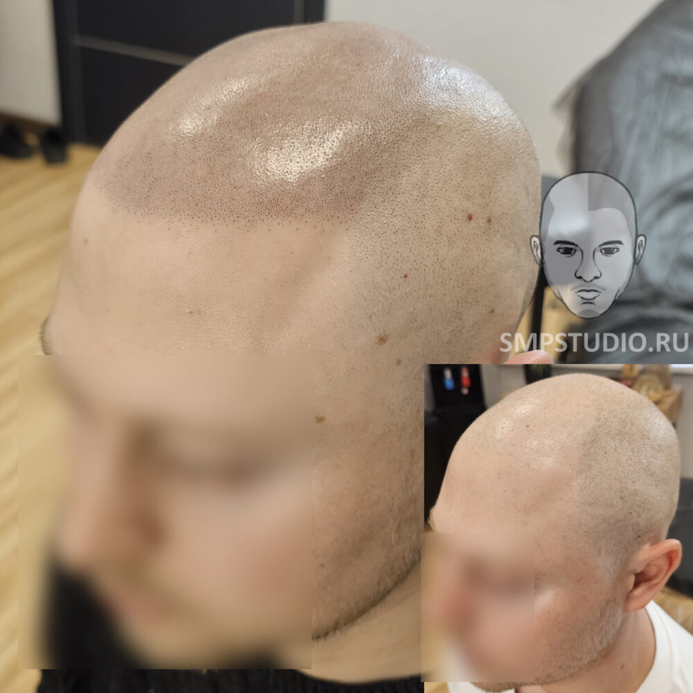Трихопигментация волос smpstudio.ru Краснодар scalpmicropigmentation