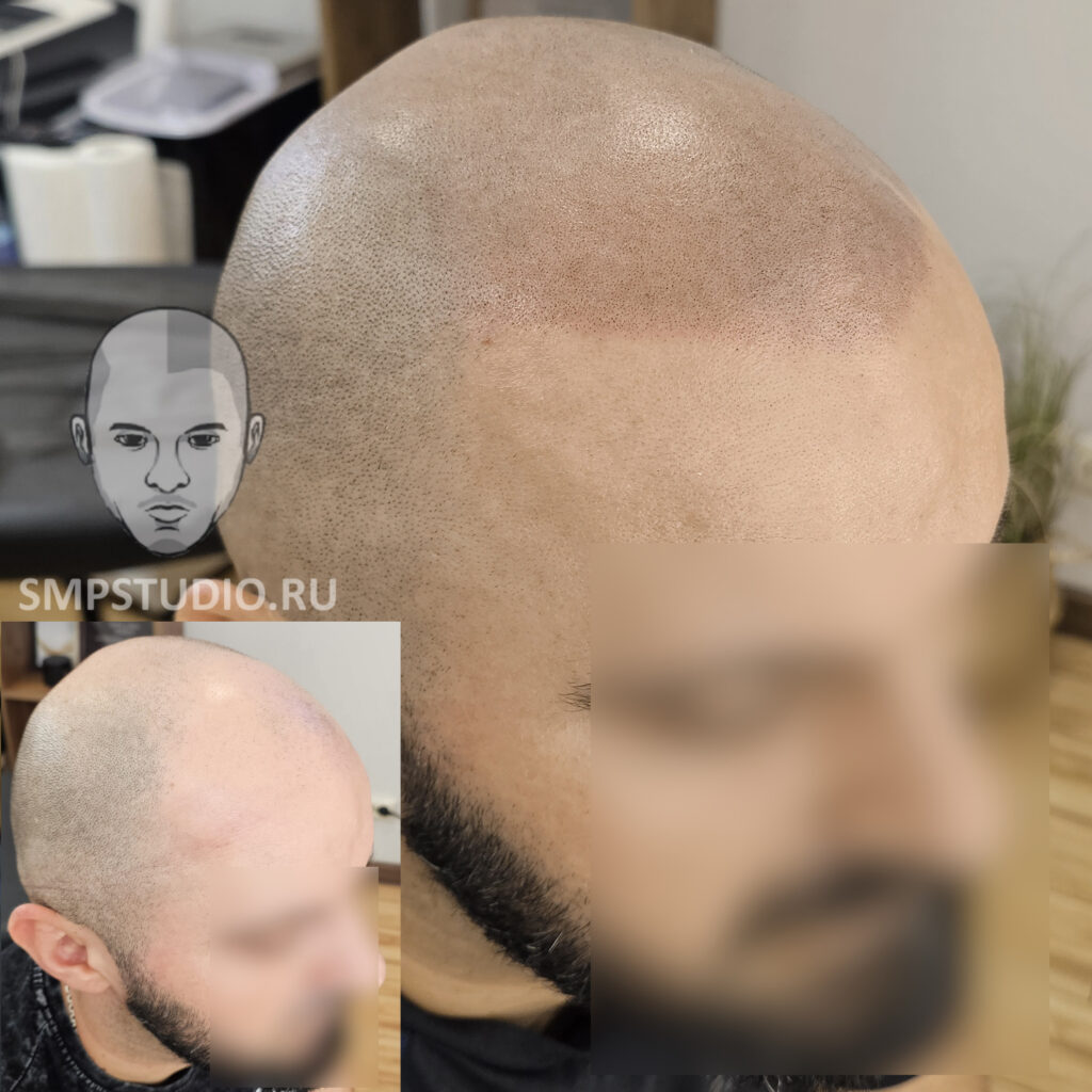 Трихопигментация волос smpstudio.ru Краснодар scalpmicropigmentation