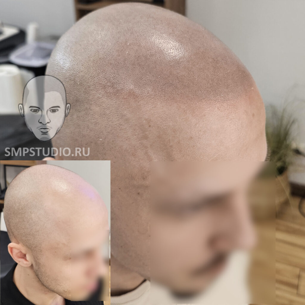 Трихопигментация волос smpstudio.ru Краснодар scalpmicropigmentation