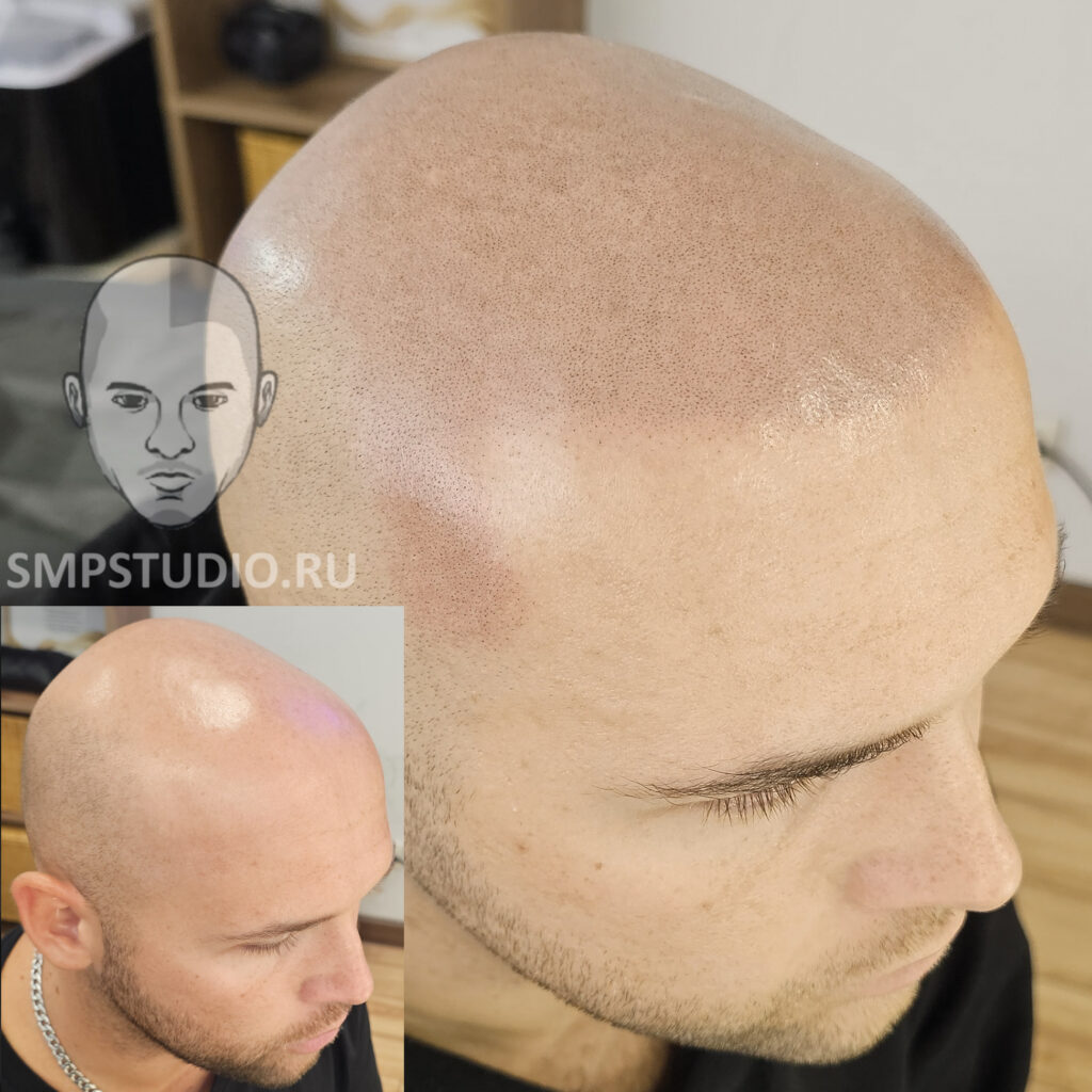 Трихопигментация волос smpstudio.ru Краснодар scalpmicropigmentation