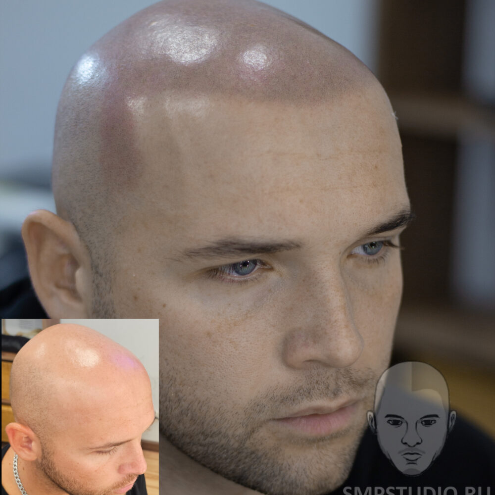Трихопигментация волос smpstudio.ru Краснодар scalpmicropigmentation