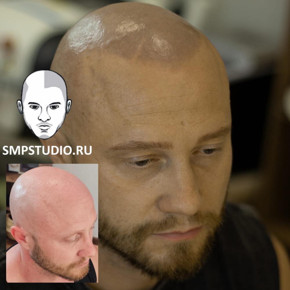 Трихопигментация волос smpstudio.ru Краснодар scalpmicropigmentation