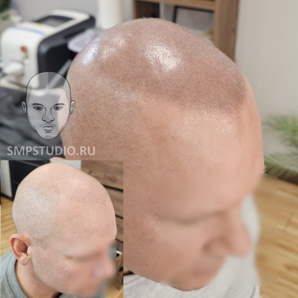 Трихопигментация волос smpstudio.ru Краснодар scalpmicropigmentation