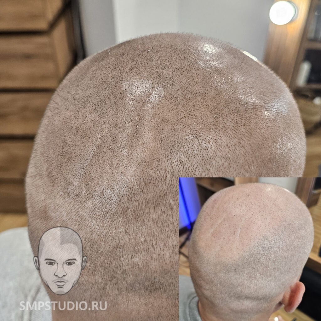 Трихопигментация волос smpstudio.ru Краснодар scalpmicropigmentation