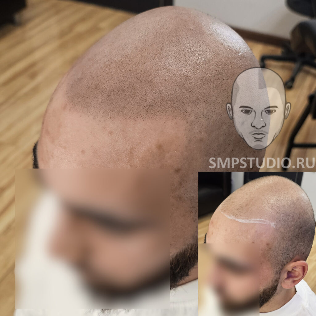 Трихопигментация волос smpstudio.ru Краснодар scalpmicropigmentation