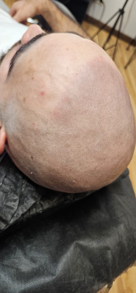 Трихопигментация волос smpstudio.ru Краснодар scalpmicropigmentation