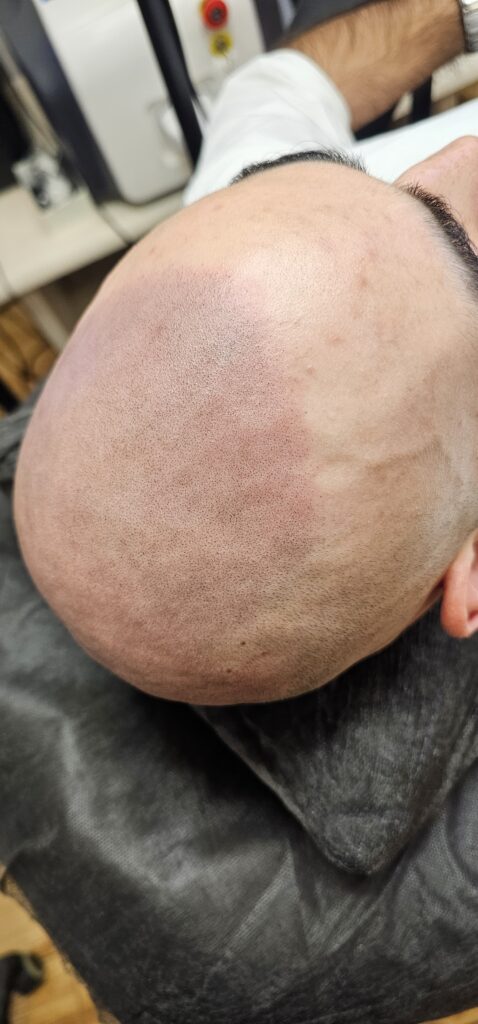 Трихопигментация волос smpstudio.ru Краснодар scalpmicropigmentation