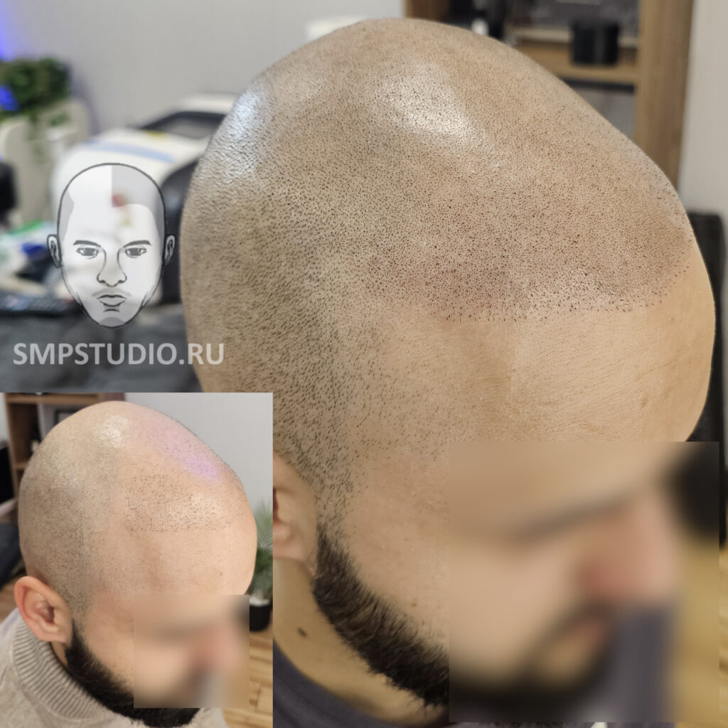 Трихопигментация волос smpstudio.ru Краснодар scalpmicropigmentation
