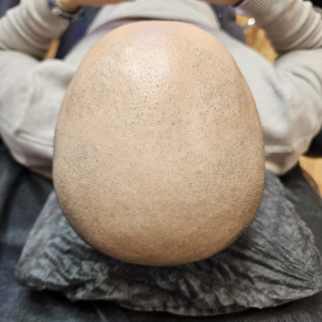 Трихопигментация волос smpstudio.ru Краснодар scalpmicropigmentation