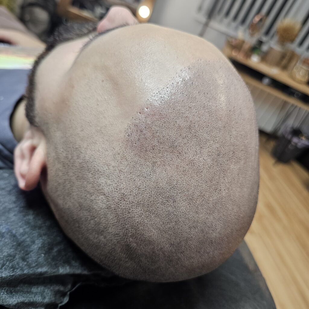 Трихопигментация волос smpstudio.ru Краснодар scalpmicropigmentation