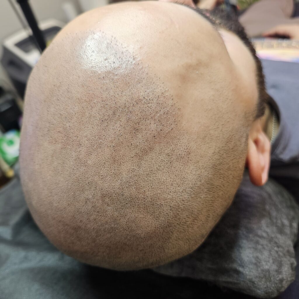 Трихопигментация волос smpstudio.ru Краснодар scalpmicropigmentation