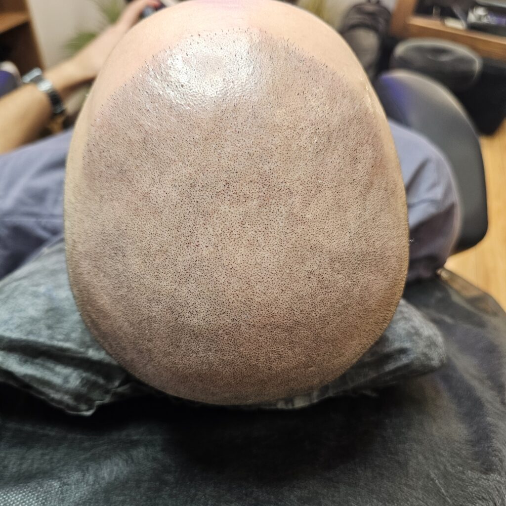 Трихопигментация волос smpstudio.ru Краснодар scalpmicropigmentation