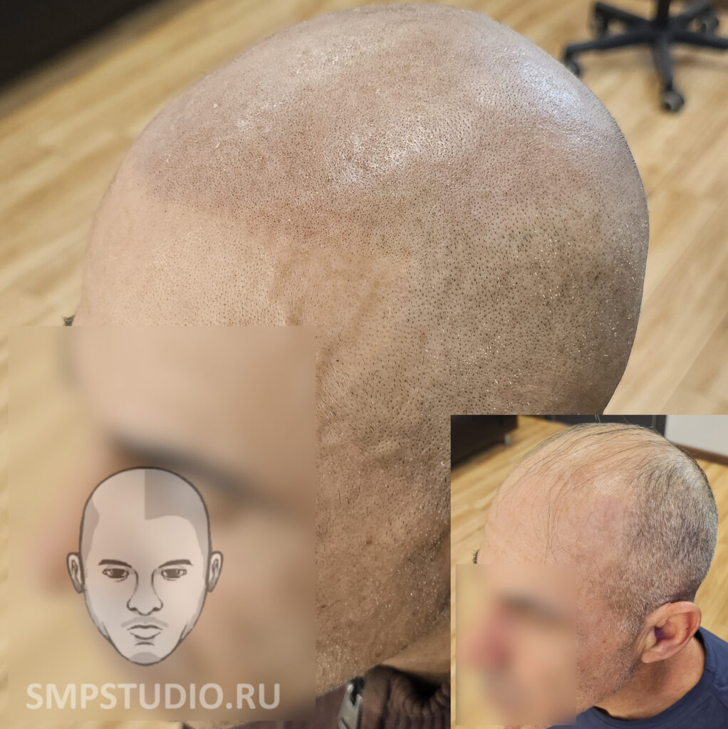 Трихопигментация волос smpstudio.ru Краснодар scalpmicropigmentation