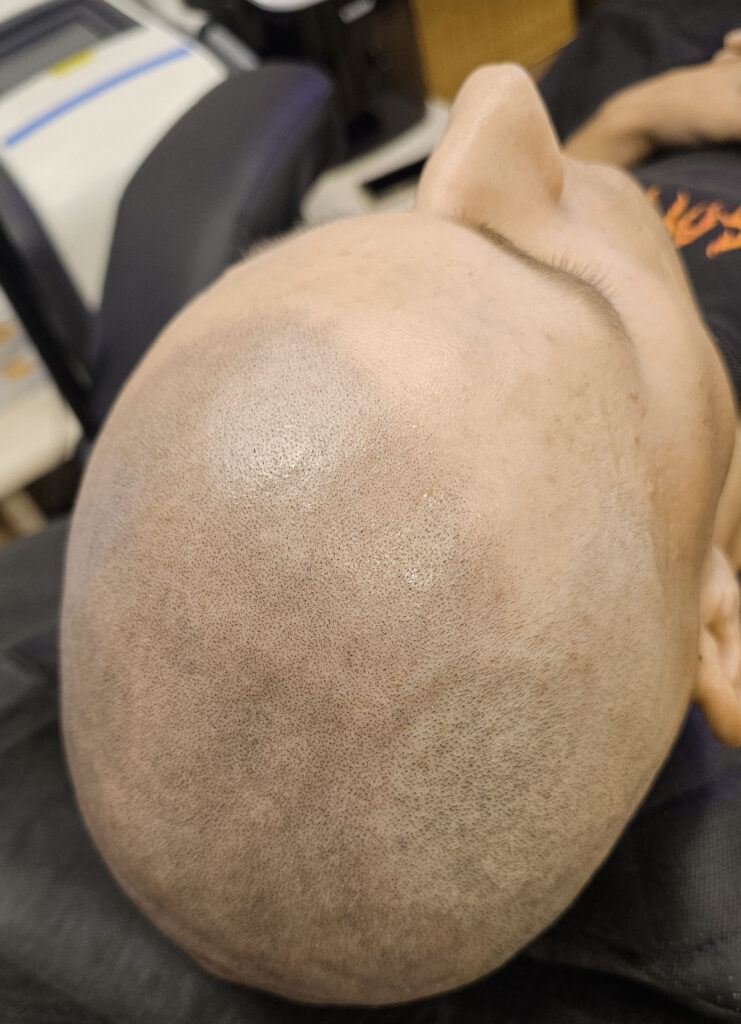 трихопигментация-волос-до-после-scalpmicropigmentation-befora-after-krasnodar-smpstudio-ru-50_1
