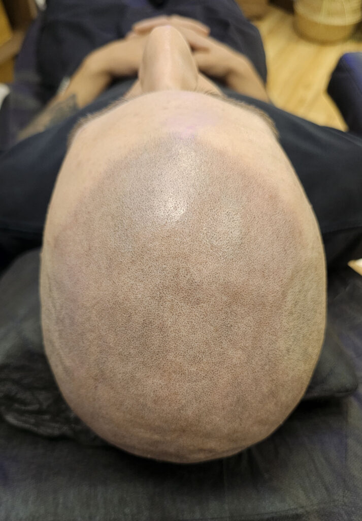 трихопигментация-волос-до-после-scalpmicropigmentation-befora-after-krasnodar-smpstudio-ru-50_1
