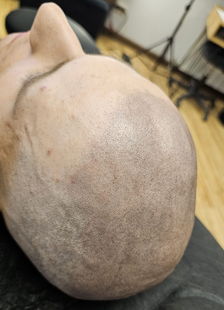 трихопигментация-волос-до-после-scalpmicropigmentation-befora-after-krasnodar-smpstudio-ru-50_1