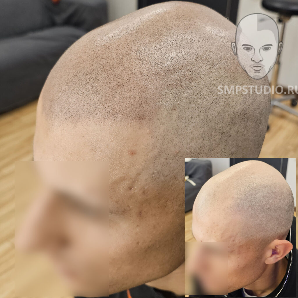 трихопигментация-волос-до-после-scalpmicropigmentation-befora-after-krasnodar-smpstudio-ru-50