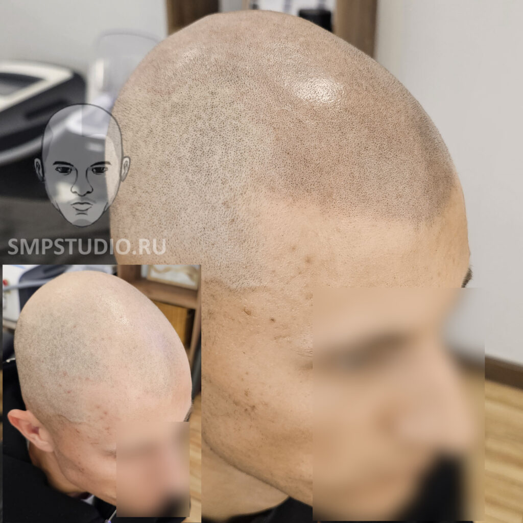 трихопигментация-волос-до-после-scalpmicropigmentation-befora-after-krasnodar-smpstudio-ru-50