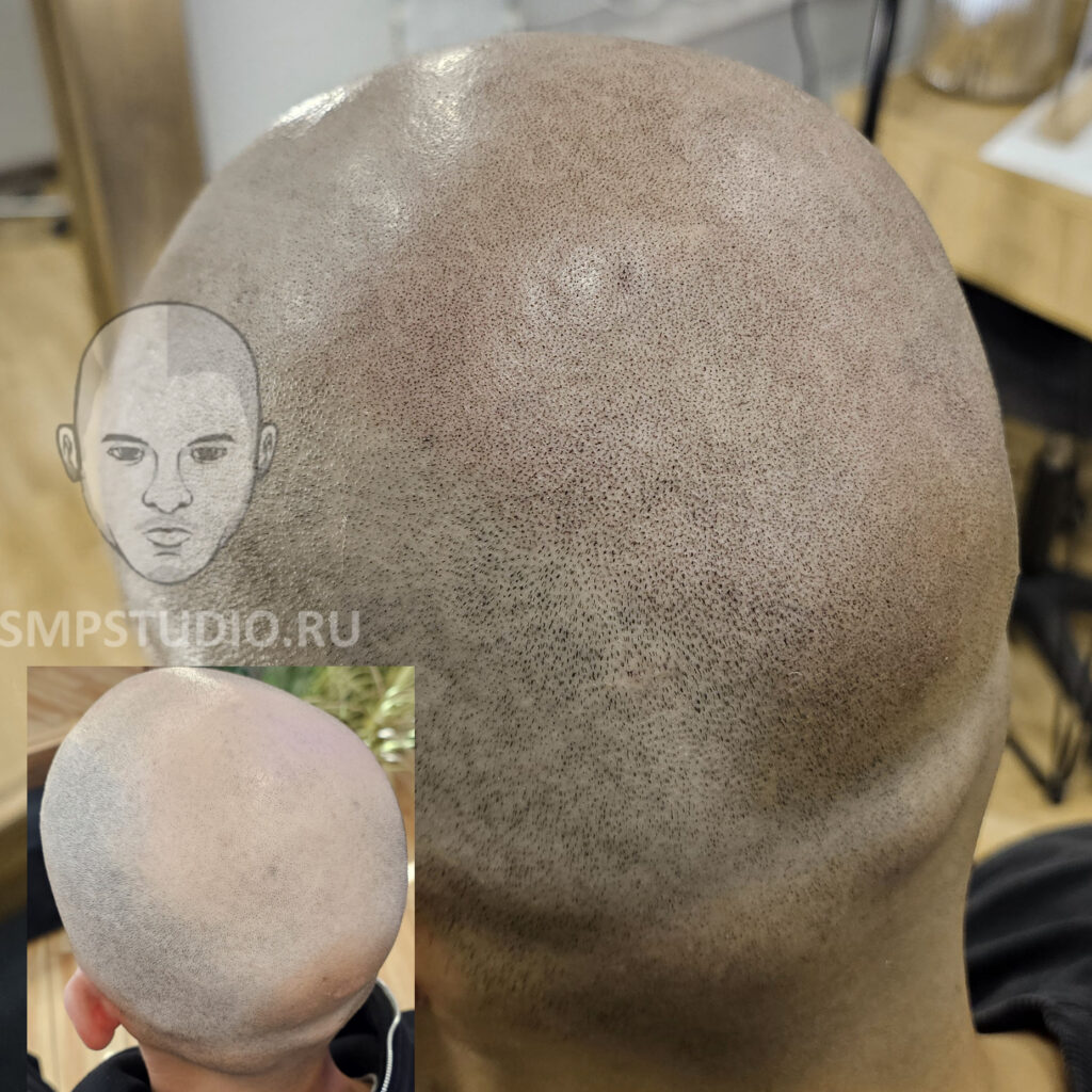 ация-волос-до-после-scalpmicropigmentation-befora-after-krasnodar-smpstudio-ru-50_back