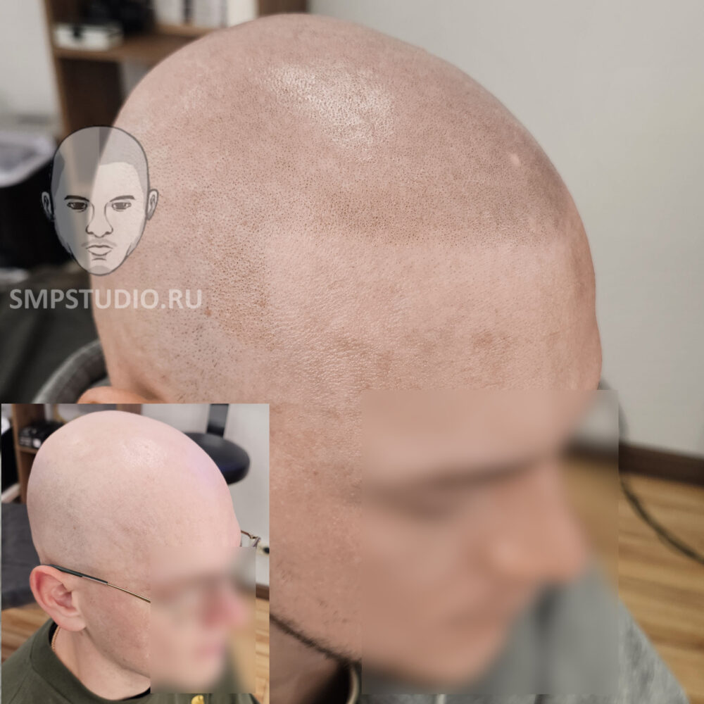 трихопигментация-волос-до-после-scalpmicropigmentation-befora-after-krasnodar-smpstudio-ru-51
