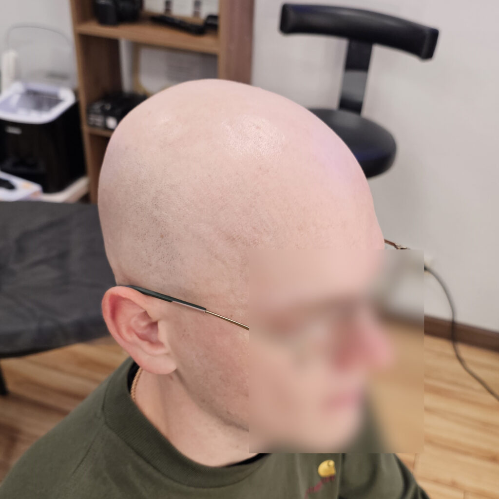 трихопигментация-волос-до-после-scalpmicropigmentation-befora-after-krasnodar-smpstudio-ru-51_2