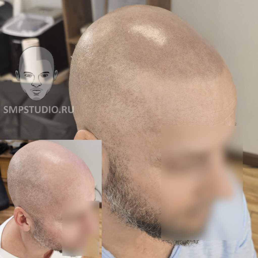 трихопигментация-волос-до-после-scalpmicropigmentation-befora-after-krasnodar-smpstudio-ru-52