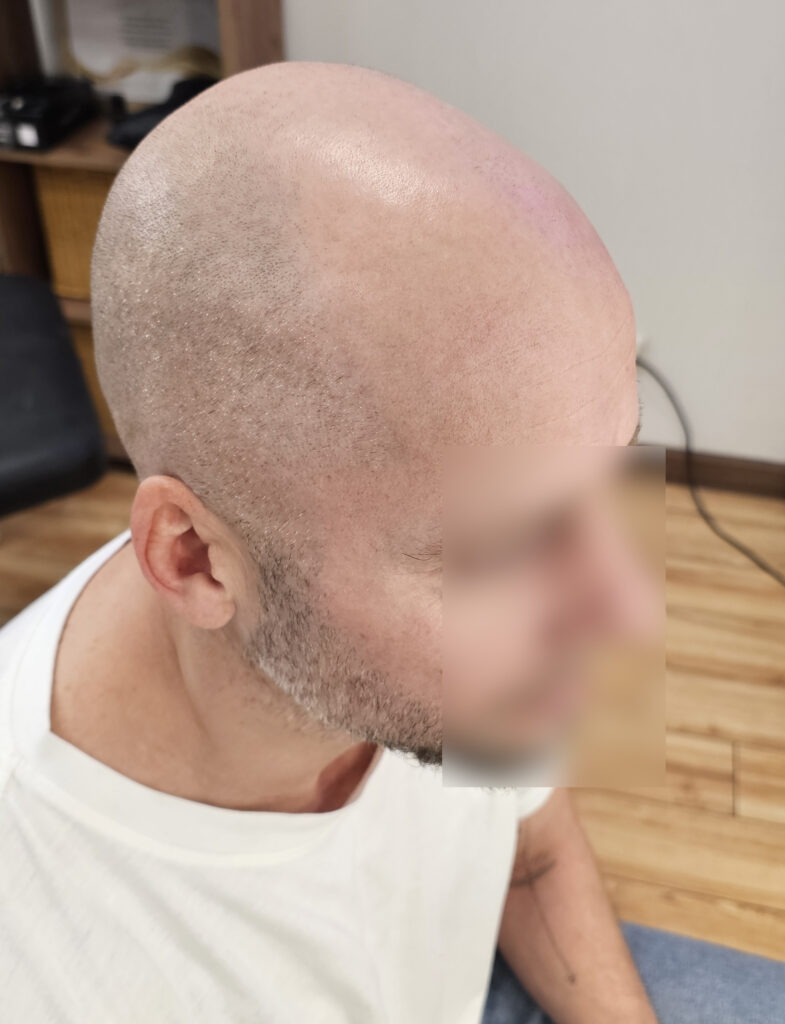 трихопигментация-волос-до-после-scalpmicropigmentation-befora-after-krasnodar-smpstudio-ru-52_1