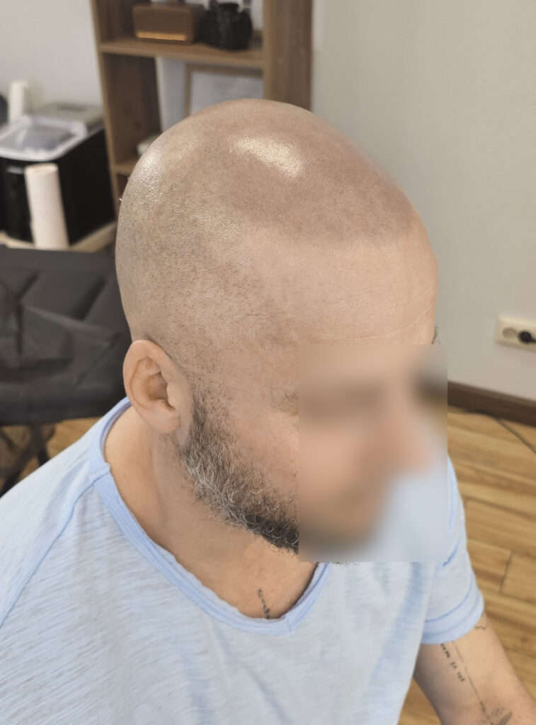трихопигментация-волос-до-после-scalpmicropigmentation-befora-after-krasnodar-smpstudio-ru-52_1