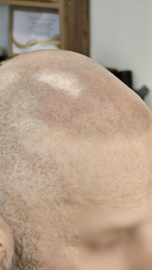 трихопигментация-волос-до-после-scalpmicropigmentation-befora-after-krasnodar-smpstudio-ru-52_3